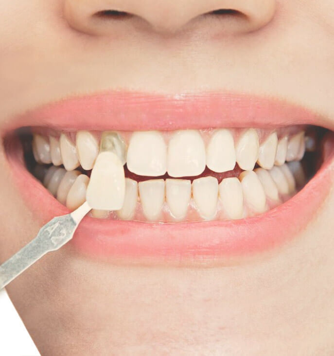 Estética dental: carillas o coronas