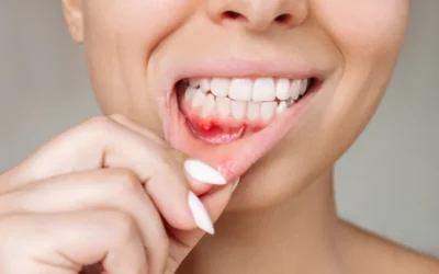 Aftas bucales: por qué salen y cómo dejar de sufrir cada vez que comes