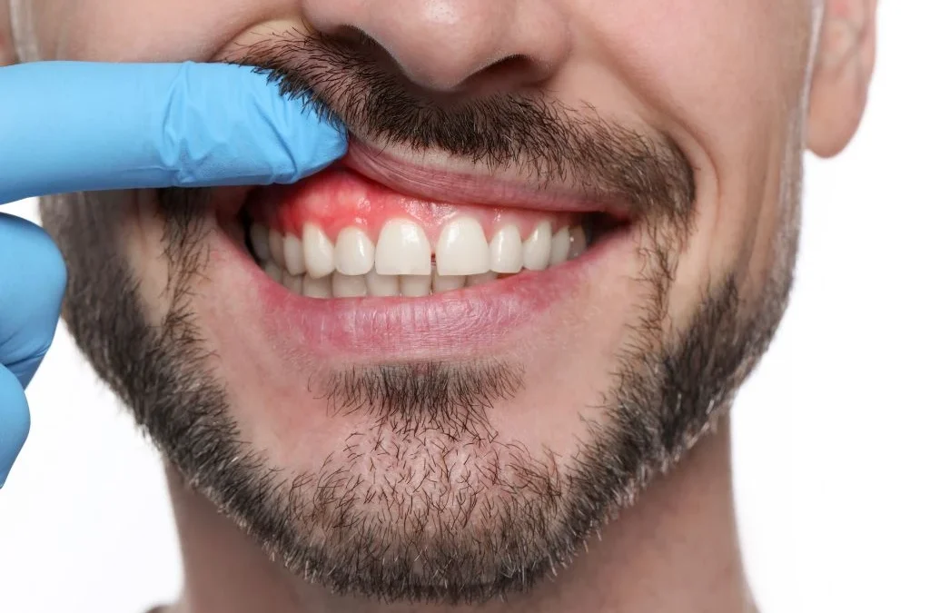 Bulto en la encía: causas, tipos y cuándo ir al dentista