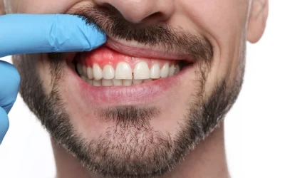 Bulto en la encía: causas, tipos y cuándo ir al dentista
