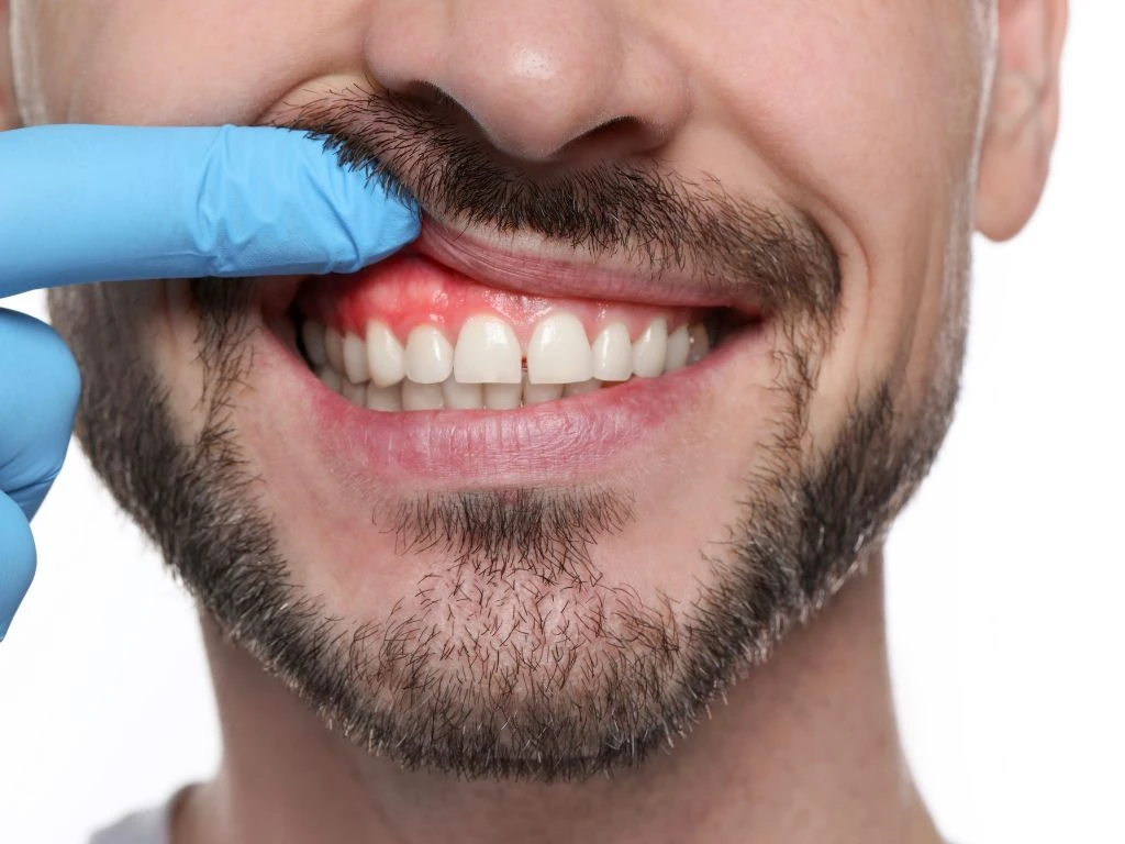 Bulto en la encía astigarraga | Clínica dental Astigarraga