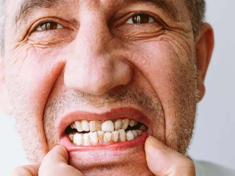 ¿Por qué se me caen trozos de dientes?