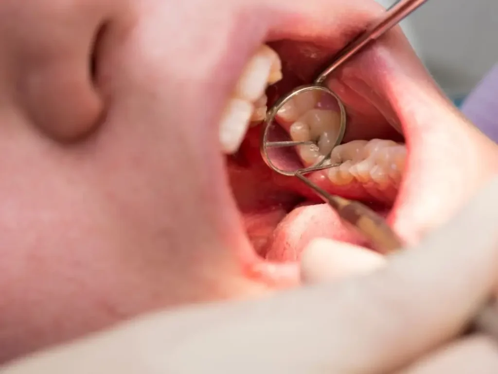 Caries dental en Clínica dental Astigarra