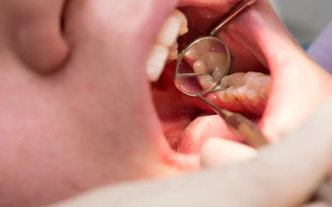 Caries dental: causas, síntomas, tratamiento y prevención