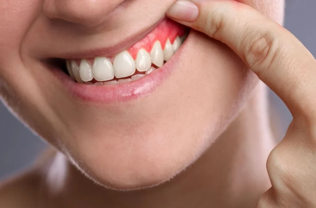 Encías inflamadas: causas, síntomas y tratamiento