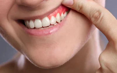 Encías inflamadas: causas, síntomas y tratamiento