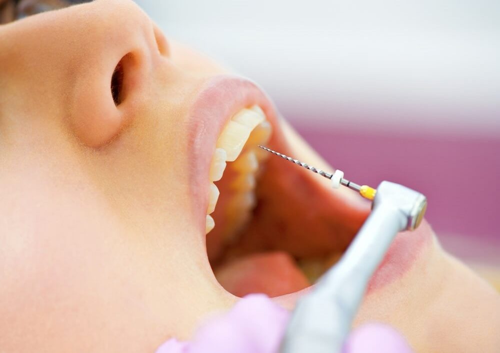 Endodoncia dental