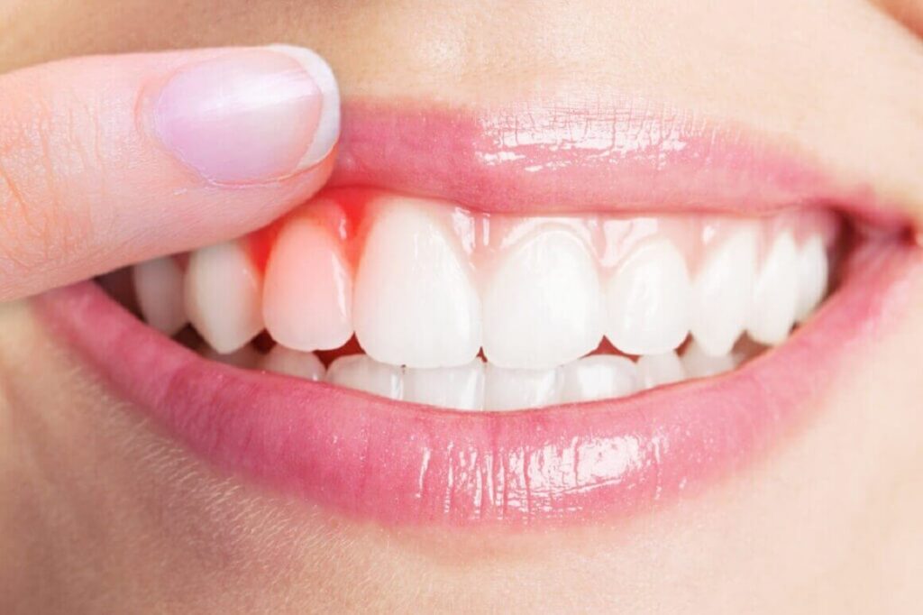 Gingivitis y periodontitis por sarro dental