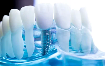 Implantes dentales en Astigarraga: cuándo se recomiendan y cómo cuidarlos