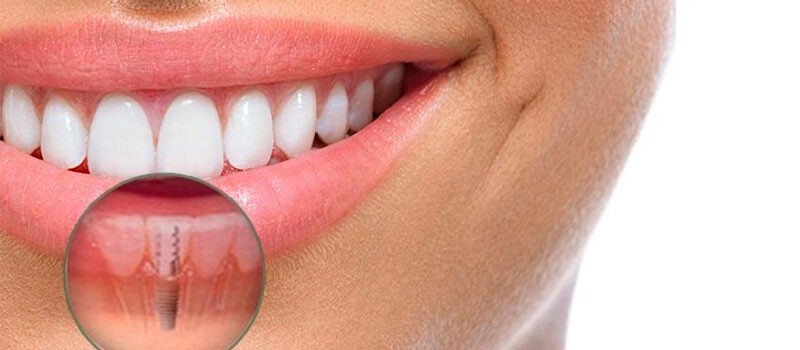Cabecera de implantes dentales