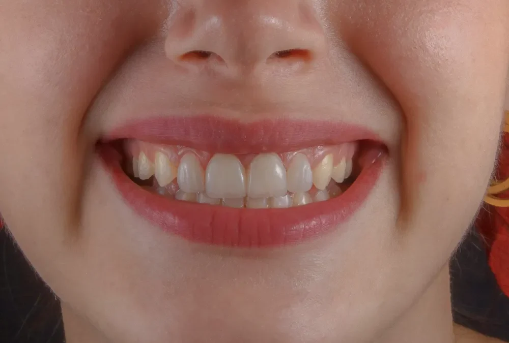 Incrustación dental: cuándo es mejor que un empaste