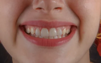 Incrustación dental: cuándo es mejor que un empaste