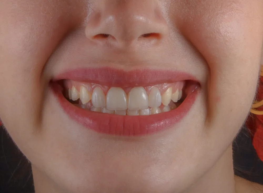 Incrustación dental inlay y onlay en clínica dental Astigarraga
