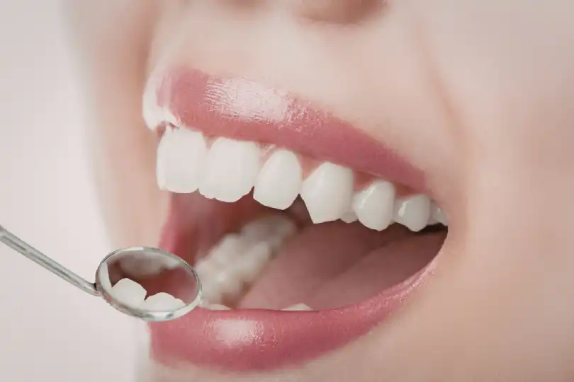 Eliminar el sarro dental astigarraga