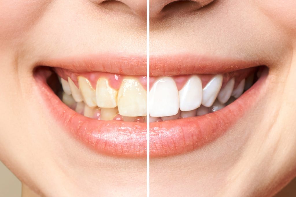 Sarro dental acumulado antes y después