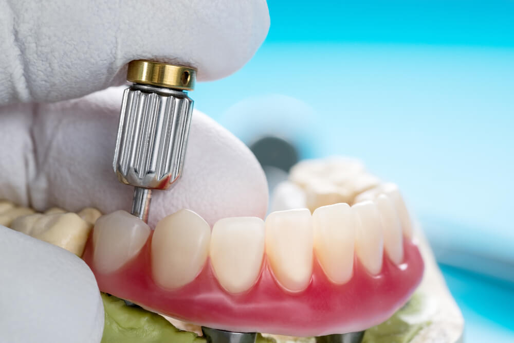 La sobredentadura es un tipo de prótesis dental