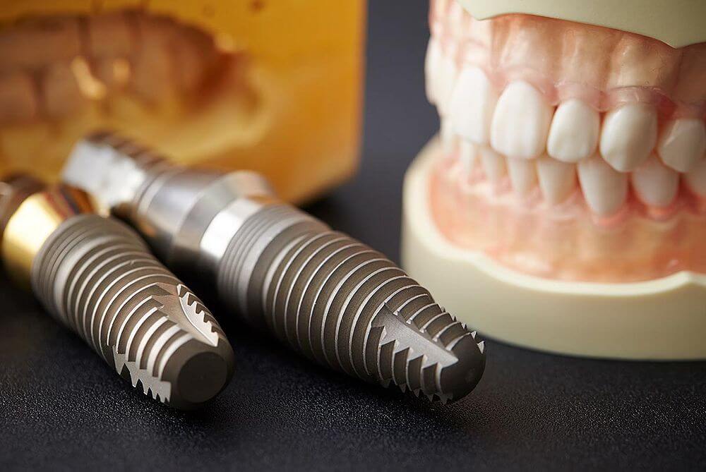 Implantes dentales cilíndricos