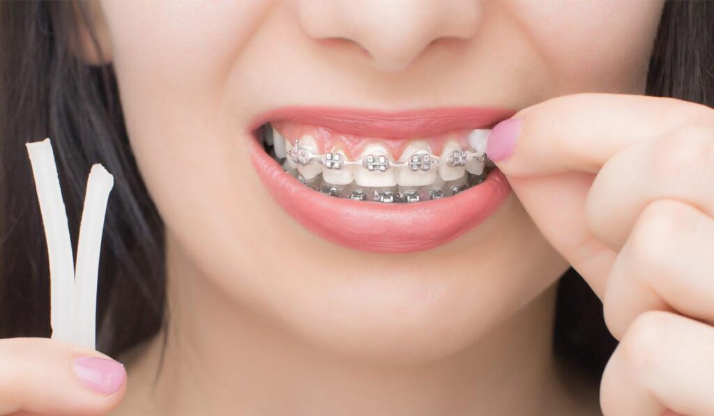 Tips para brackets: cera dental