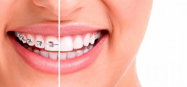 Tratamiento de ortodoncia: tips para brackets